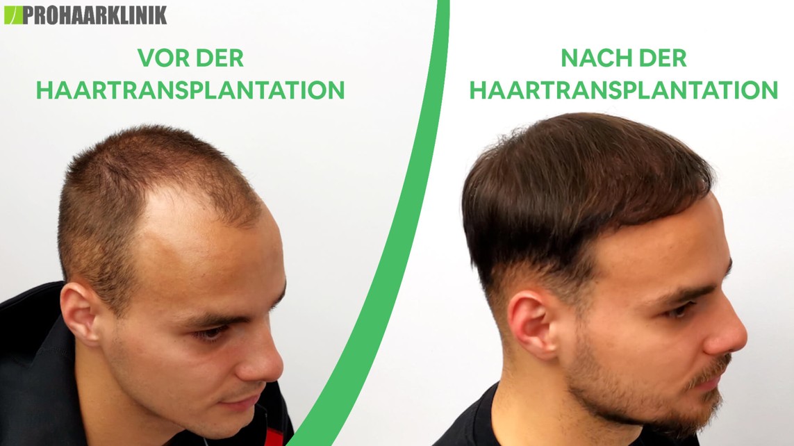 prohaarklinik haartransplantation vorher und nachher