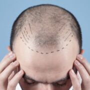 Haartransplantation